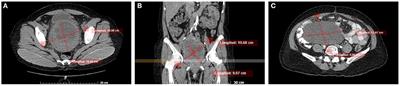 Case Report: Uterine Adenosarcoma With Sarcomatous Overgrowth and Malignant Heterologous Elements